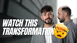 Superhairpieces M104 Hair System Looks INSANELY Good😱 | Toupee Transformation