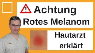 Achtung: Rotes Melanom, schwer zu erkennen. Hautarzt erkl&auml;rt | Dr. Kasten Hautmedizin in Mainz