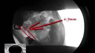 AlarAccessoryligamentDamage (Broken neck)