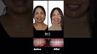 Incredible Smile Transformation #drzsmiles #dentist #smile #smiledentist #incredible