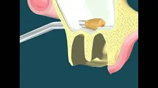 Dental Video of Root Tip in Sinus Retraction - The Tooth