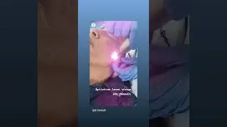 S&eacute;ance d'&eacute;pilation d&eacute;finitive au niveau du visage. #laser @fotonafrance