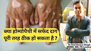 क्या सफेद दाग पूरी तरह से ठीक हो सकता है ? | Vitilago treatment | Leucoderma treatment | चरक का ईलाज