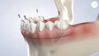 Full-Arch Restoration in Modesto CA | Greater Modesto Dental Implant & Oral Surgery Center