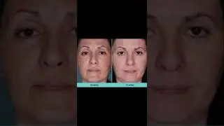 Metox 100: Radiance Redefined &ndash; Unlock the Next Level of Glow.#FacialAesthetics #DermatologyClinic