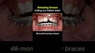 Magic Braces: Pull out hidden teeth process #braces #dentist #orthodontist #orthodontics