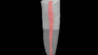 Mct - Flat Oval Root Canal Treated Using the SAF System