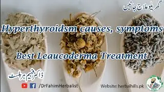 Hyperthyroidsm causes symptoms ll Best Leaucoderma Treatment ll Kidney stone disease (Male Patient)