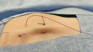Suture &agrave; points s&eacute;par&eacute;s en U (horizontal)