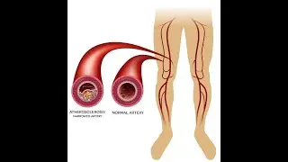 Blood vessel disorders  ; Definition, Causes, types, Symptoms, Diagnosis, treatment