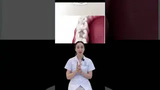Phuơng ph&aacute;p phục h&igrave;nh răng sứ Inlay onlay #nhakhoaachau #dentist