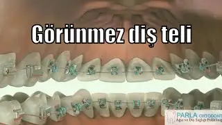 Görünmez diş teli ( lingual braket ) - Saklı tel