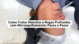 Transforma&ccedil;&atilde;o da Pele Fotoenvelhecida: Microagulhamento T&eacute;cnico Para Profissionais