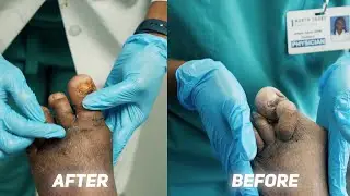 Fixing Overlapping Toes! | Left Foot Bunionectomy and 2nd Digit Hammertoe Correction (Part 2)
