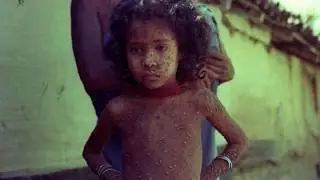 The Smallpox Vaccine: Ending 3,000 Years of Torture