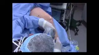 Endovenous Radiofrequency Ablation Training Video