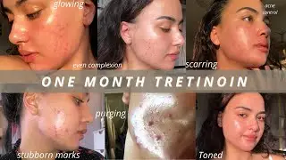 WHY I CANCELLED MY HARLEY STREET DERMATOLOGY APPOINTMENT | TRETINOIN 1 MONTH UPDATE | #Dermatica