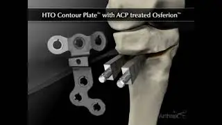 Wysoka koślawiąca osteotomia piszczeli - animacja 3D z wyjaśnieniem