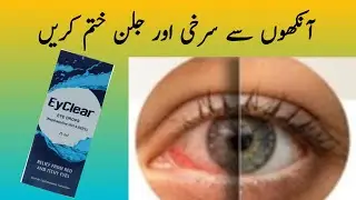 How to remove eye irritation | How to get rid of eye pain and redness | Naveedshaheen-01