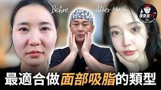 面部吸脂適合哪些人？醫師從臉型、脂肪層到年齡完整解析
