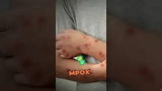 New Mpox Strain Emerges