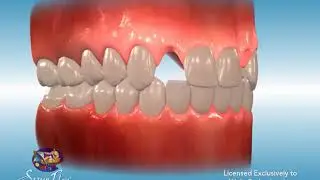 Braces Laterals