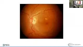 Indications for Retina Laser Treatment: Dr. Clio Armitage Harper III