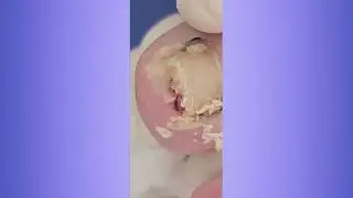 ​ Nails​ #ingrowntoenailremoval#ingrown #surgery #nailsdone #nailsasmr #pedicure #viralvideos