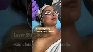 Laser skin tightening with GentleMax Pro #facials #skincare #medspa #facial #laserskintightening