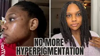 I suffered from hyperpigmentation for YEARS | Here&rsquo;s how I got rid of it & I how I prevent them!