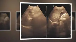 Ultrasound cases 430 of 2000 || Epigastric mass with hepatic hemangioma mild ascites