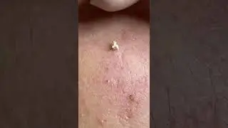 Satisfying Pimple Popping Compilation &ndash; Deep & Clean Extractions!