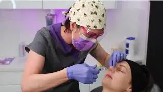 Non surgical Nose Job at Smileworks