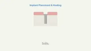 Dental Implant Guide 101