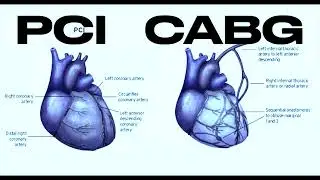 Podcast #1: CABG vs. PCI