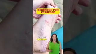 Bolhas nos p&eacute;s e m&atilde;os por estresse? Descubra a disidrose agora!