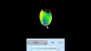 scintigraphie myocardique