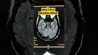 Multiple Granulomas #mri #shorts #trending