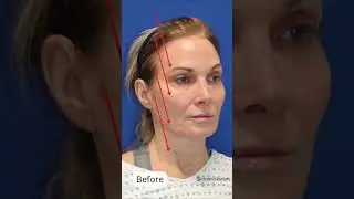 Jaw-Dropping Facelift at Age 65