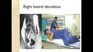 Barium Enema, procedure and patterns