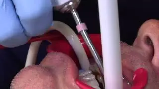 Invisalign - Part 1