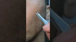 #ingrown #تجميل #extraction #hairissue