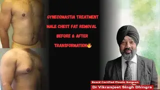 Gynecomastia Treatment | Male Chest Fat Removal | Before & After Transformation 💪🔥 Dr. Vicky Dhingra