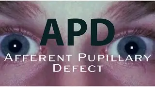 How to detect an APD:  Afferent Pupillary Defect