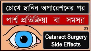 Cataract Surgery Side Effects: #cataract #cataractSurgery #cataractOperation  #doctorSight