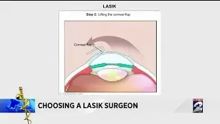 Choosing a LASIK surgeon