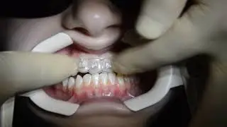 Indirect Digital Bonding  System &ldquo;Easy Brace&rdquo;