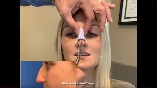 Rhinoplasty Portland Oregon | Nose Surgery Portland OR