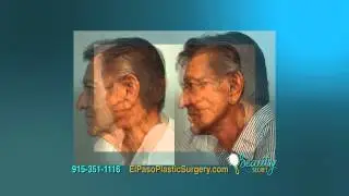 El Paso Cosmetic Surgery Dr. Ozan Sozer - Neck Lift