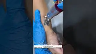 Laser Tattoo Removal in Kochi | Safe & Effective Tattoo Removal at SkinPal